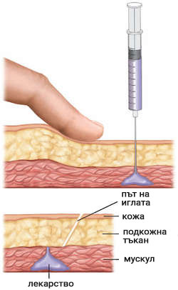 инжектиране на стероиди